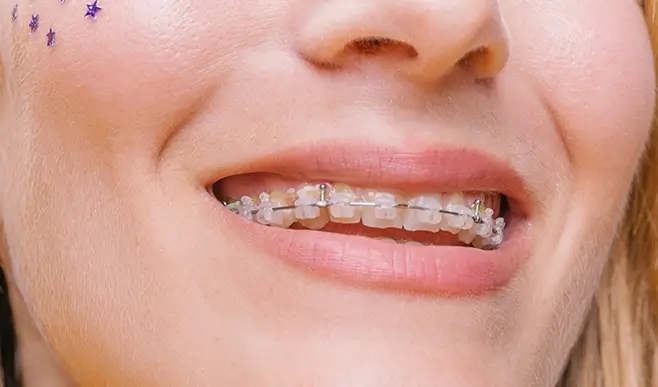 Ceramic Braces