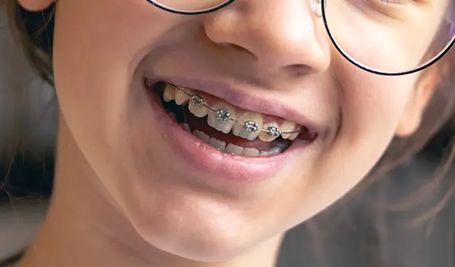 Damon Braces