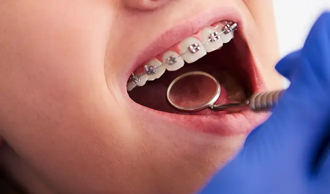 Metal Braces