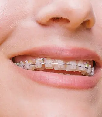 ceramic braces