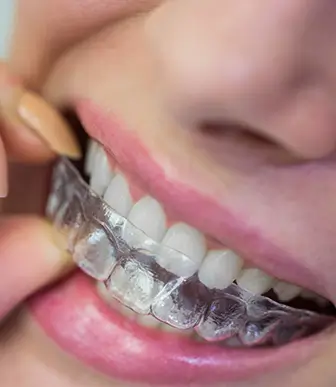 Invisalign Braces